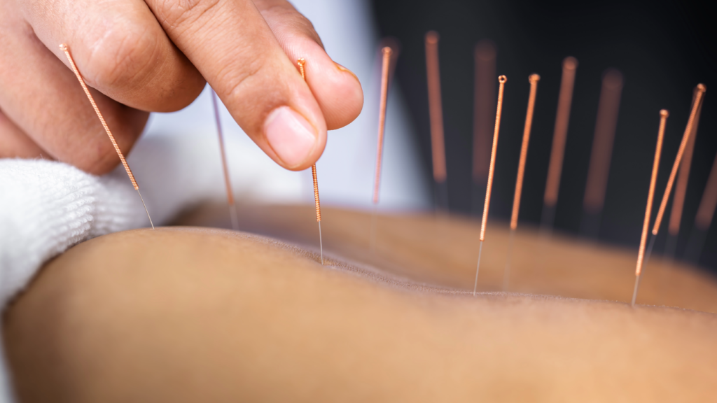 Acupuncture