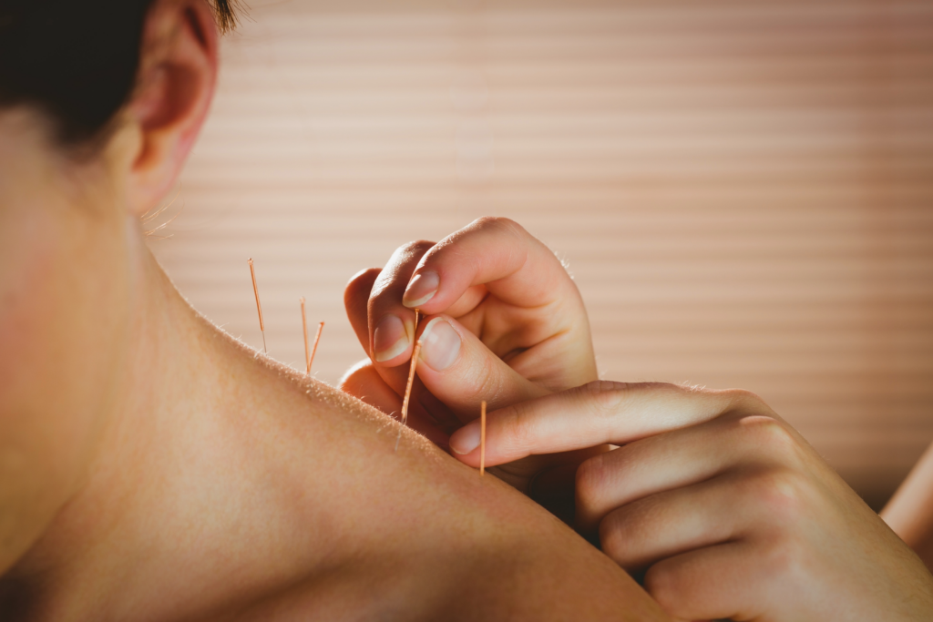 acupuncture at Your Journey Health Club