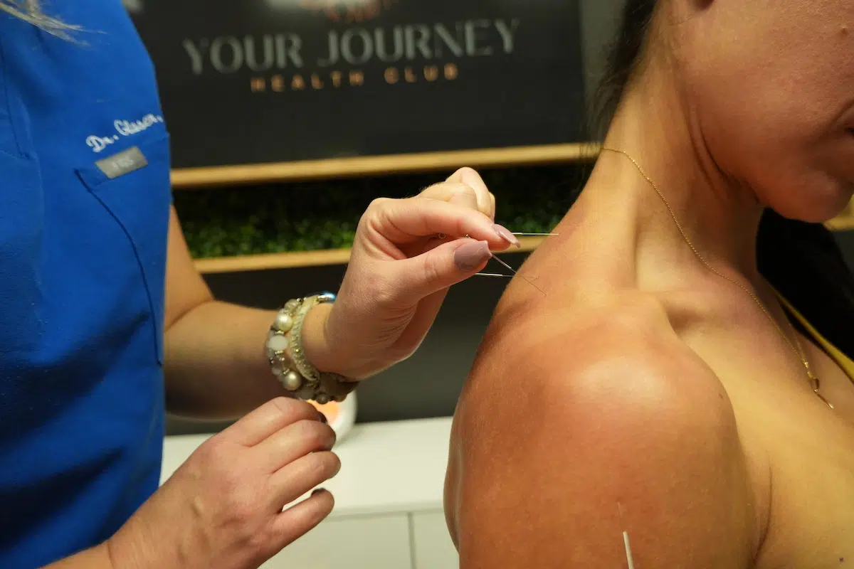 Acupuncture services