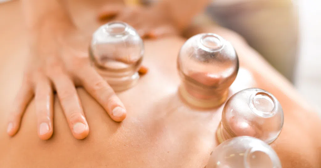 Cupping therapy in trinity fl