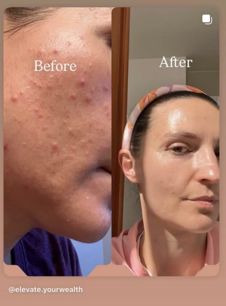 Close-up comparison of a person's skin before and after using Olive Rose, showing reduced redness and smoother texture.